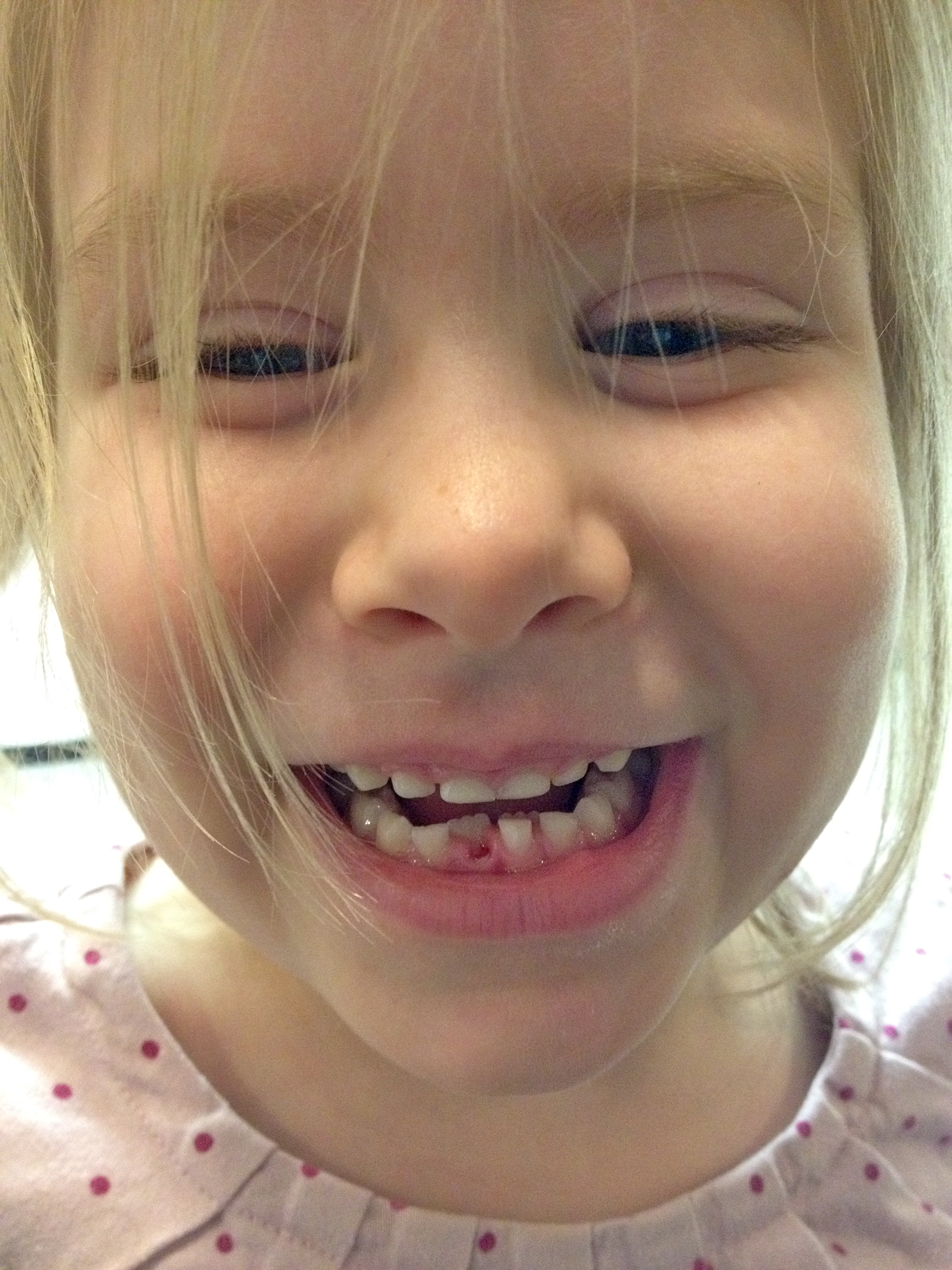 losing first tooth